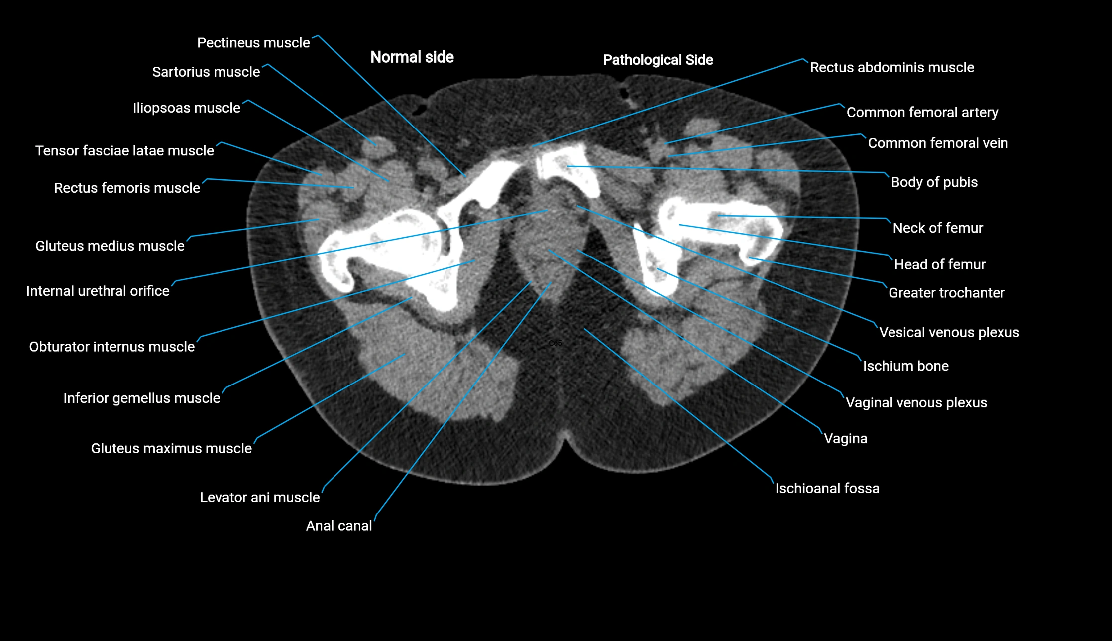 CT KUB axial cross sectional anatomy  radiology image -img-00201-00169.webp